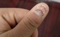 门夹过的指甲怎么修复好看-门夹过的指甲怎么修复好