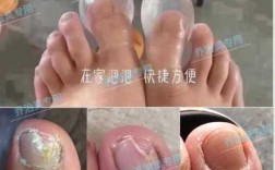 灰指甲怎么能治好? 灰指甲怎么修复最快