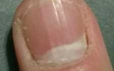  指甲盖表面怎么修复不疼「指甲盖表面怎么修复不疼痛」
