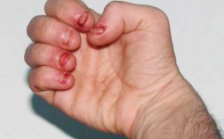 咬指甲治疗方案 严重咬指甲指甲修复