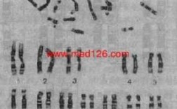 吉姆萨染色细胞 染色体被吉木萨染料染色后显示的G带是