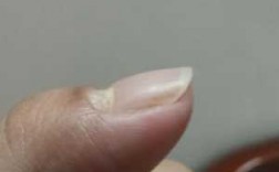 指甲凹陷怎么改善-如何修复指甲表皮凹陷处