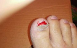 指甲盖撞了一下怎么缓解疼痛 指甲盖撞到了怎么修复