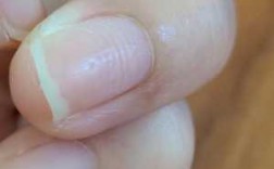 指甲大面积凹陷是什么病