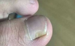 指甲空洞是灰指甲吗 指甲空洞修复要多少钱呢
