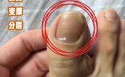 灰指甲好几层-灰指甲指甲分层怎么修复