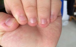  咬指甲甲床短能修复吗怎么办图片「咬指甲指甲短怎么办」
