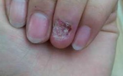 指甲损坏多年能修复吗