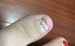  如何短期修复指甲盖「修复断裂指甲」
