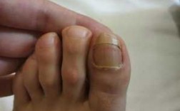 脚指甲有断层怎么修复