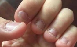 长期咬手指甲会怎么样 长期咬指甲怎么修复好呢