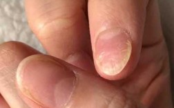 指甲甲床受损修复得多长时间_指甲的甲床受损就长不出指甲了吗