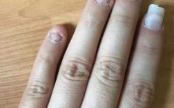 咬指甲甲床受损如何修复视频 咬指甲甲床受损如何修复