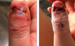 咬指甲修复大拇指视频教程,咬大拇指甲代表什么意思? 