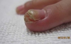  儿童指甲严重变形了能修复吗「儿童指甲变形怎么办」