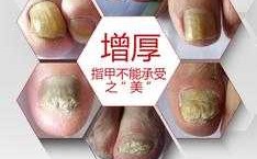 增厚型灰指甲怎么修复视频（增厚型灰指甲用什么药）