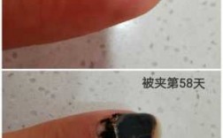 被夹指甲修复要多久好_被夹指甲康复过程