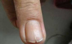 指甲很容易开裂是什么原因
