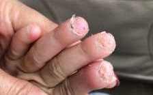 指甲被夹后裂开修复要多久-指甲被夹后裂开修复