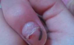 外伤指甲盖勾甲怎么修复