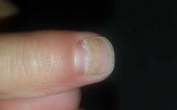 指甲盖脱落前兆-指甲盖脱了怎么修复