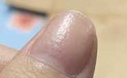 指甲凹陷需要补什么 指甲有凹坑修复要多少钱
