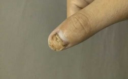 指甲盖受伤修复要多久好