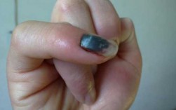 指甲盖掉了有什么征兆 指甲盖掉了要怎么修复