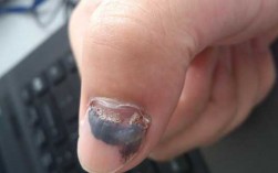 指甲里面的淤血恢复要多久 指甲里面淤血自己修复