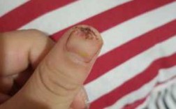 指甲被切怎么修复伤口图片,指甲被切怎么修复伤口图片 