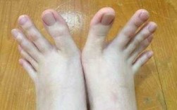 大脚趾指甲畸形修复要多少钱呢