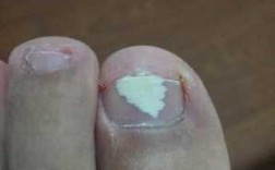  脚指甲损坏可以修复吗多少钱「脚指甲坏了怎么治疗」