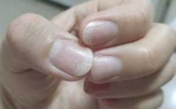 指甲片了需要注意什么问题-指甲片不合适怎么修复好