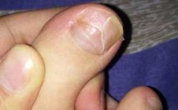 一般脚指甲盖掉了几天能修复好（一般脚指甲盖掉了几天能修复好啊）