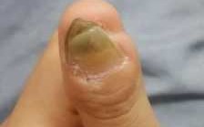 男生指甲畸形矫正修复要多少钱,指甲畸形修复整形多少钱 
