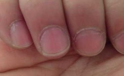 指甲盖后边起层什么原因-指甲后端起翘修复方法图解