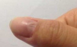 真皮的指甲划痕怎么修复,真皮被指甲划了一下怎么修复 