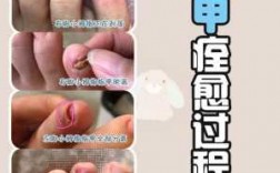 灰指甲的修复方法 灰指甲修复小妙招