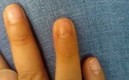 如果指甲变形了该怎么办-指甲严重变形了能修复吗