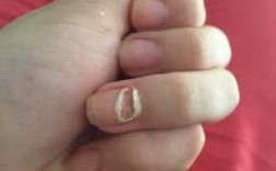 指甲中间破了个洞会长出来吗