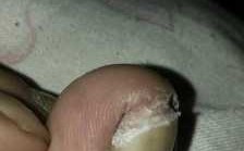 脚指甲扎肉里是什么病-脚指甲尖扎肉了怎么修复