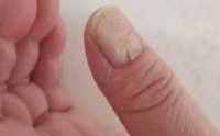 指甲有裂缝修复多少钱一次_指甲裂缝了