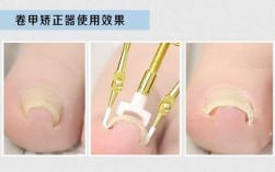 指甲修正器使用方法 指甲修复矫正器有用吗