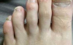 脚指甲凹陷痘坑修复男药膏,脚指甲盖有坑 