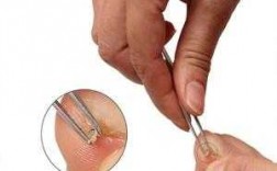 镊子宽指甲变窄修复手术,指甲短宽整形 