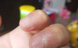 指甲脆易破裂是什么原因
