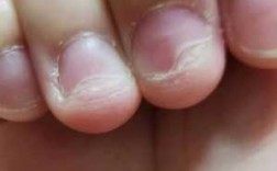 指甲创伤变形修复