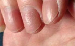 指甲皮肤角质层薄怎么修复