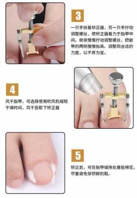 指甲修正器使用方法-指甲修复矫正器-图1