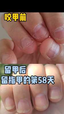 咬手指甲矫正修复视频-图1